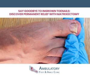 Say Goodbye to Ingrown Toenails Discover Permanent Relief with Matrixectomy